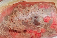 Wound with maggots under mesh cover Courtesy of Mayo Clinic