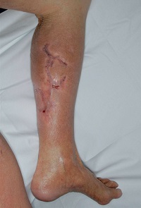 Wound 6 months after maggot treatment Courtesy of Mayo Clinic