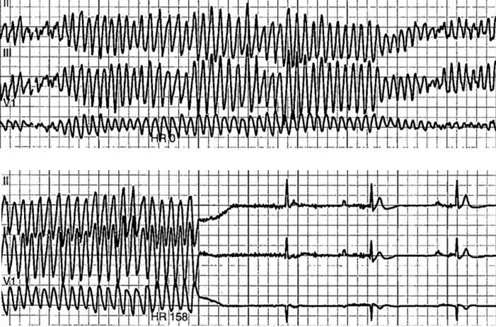 Figure Telemetry strip demonstrating polymorphic ventricular tachycardia