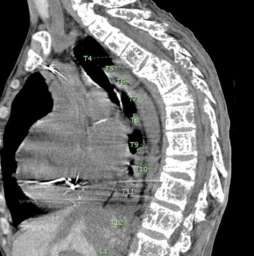 Figure 3 CT myelogram notable for sites of extramedullary hematopoiesis