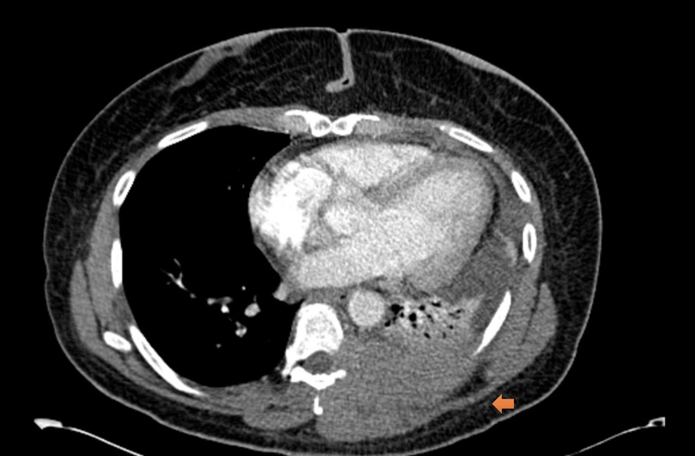 Figure 8 CT angiogram of the chest with an aggressive mass lesion seen at the left lateral and posterior paraspinal space with osseous lytic lesions red arrow