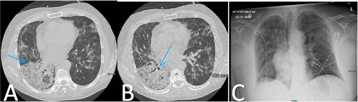 Figure 1 On day 65 CT showing bilateral ground-glass opacities A B and chest X-ray showing interstitial infiltrates C