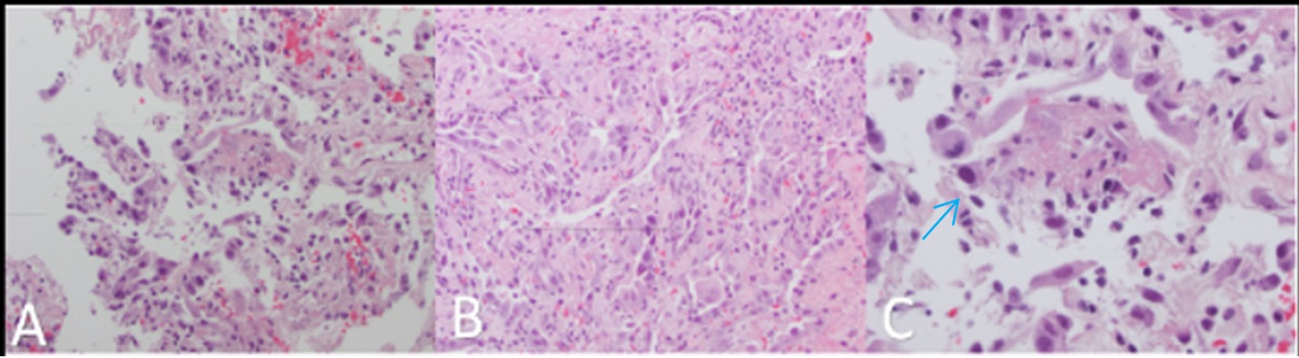 Figure 2 Transbronchial biopsy showing intact alveolar membranes within alveolar spaces A B and organizing phase of hyaline membranization C