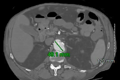 Figure 5 CT angiography revealing an acute penetrating ulcer of the suprarenal abdominal aorta extending to below the renal arteries with mild surrounding hematoma