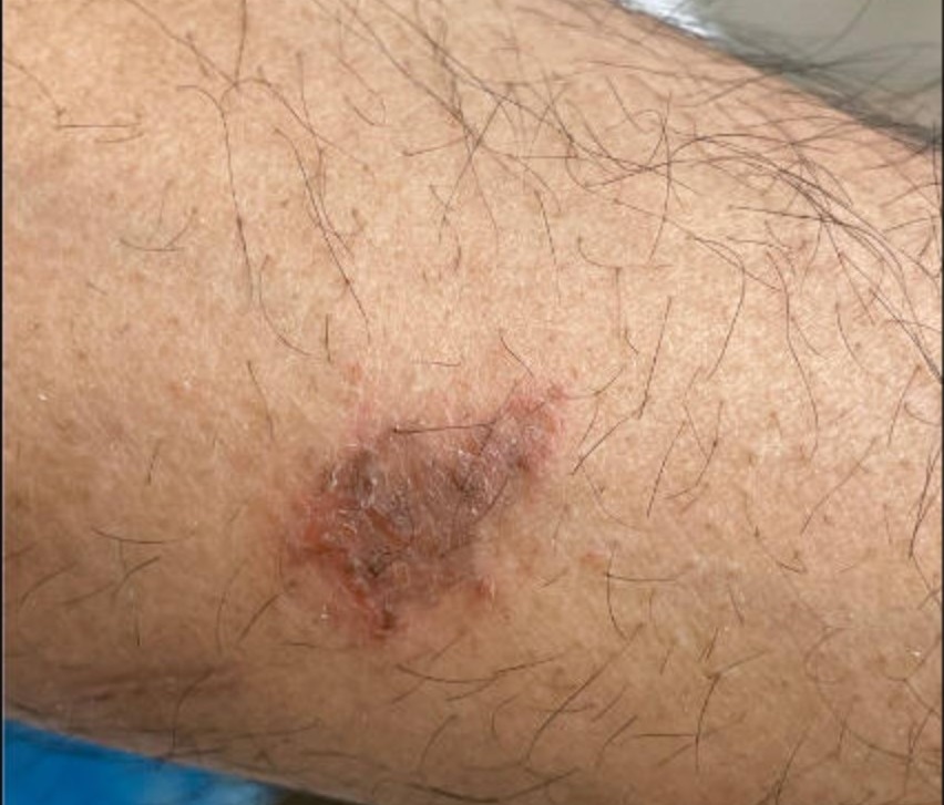 Figure 8 Verrucous lesion on forearm February 2023