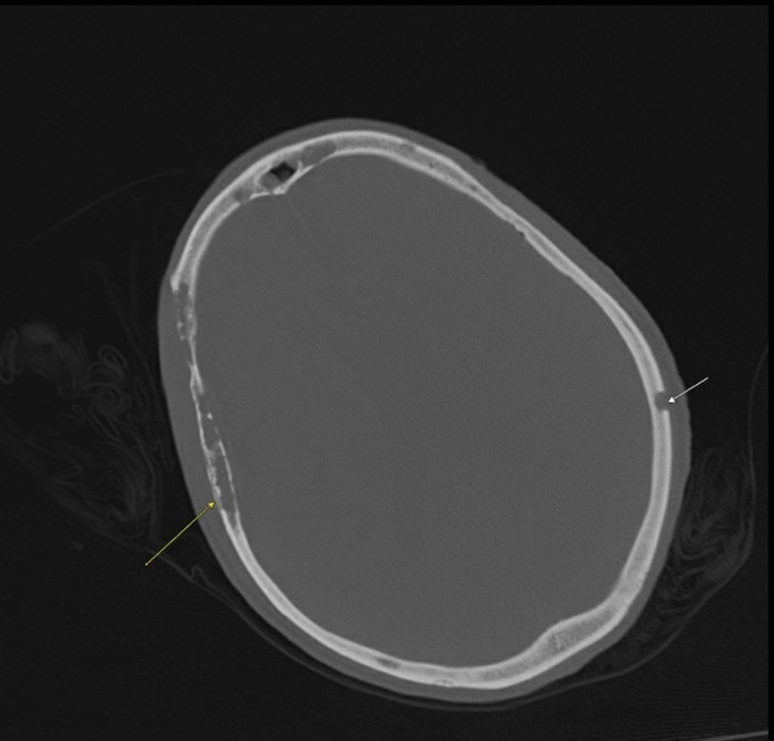 Figure Non-contrast CT scan showing osteolytic lesions throughout the calvarium arrows