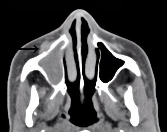 Figure 1 Noncontrast CT of frontal sinus shows periosteal erosion compared to contralateral side thin black arrow