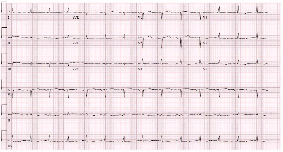 Figure 4 Electrocardiogram showing characteristic low-voltage QRS pattern